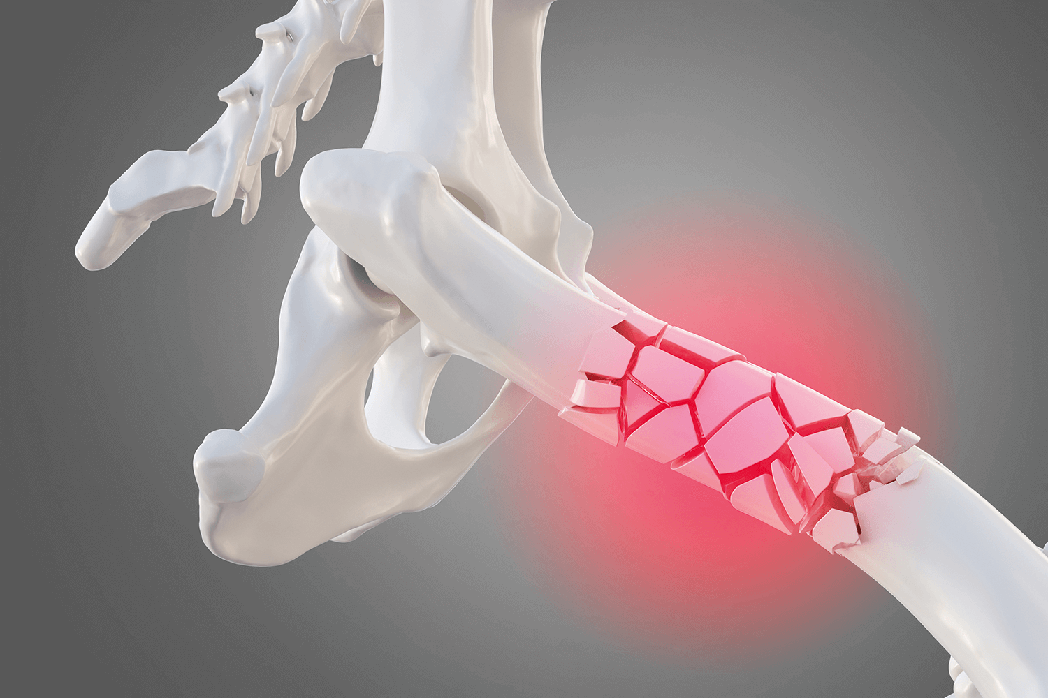 Diagnose und gezielte Therapie für Osteoporose, um das Risiko von Frakturen zu reduzieren und seine Gesundheit mit osteolabs zu verbessern.
